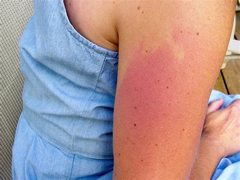 itchy bumps after tanning bed